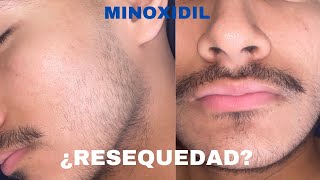 ¿CÓMO QUITAR LA RESEQUEDAD DEL MINOXIDIL EN LA BARBA [upl. by Ekle]