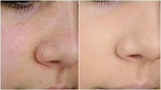 الطريقة الصحيحة لاخفاء المسام المفتوحة و شوائب البشرة نهائيا  How to Cover Up Large Pores [upl. by Corkhill]