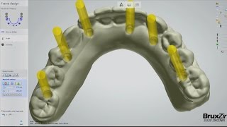 Fabrication of the BruxZir® FullArch Implant Prosthesis Vol 1 Issue 2 [upl. by Lula455]