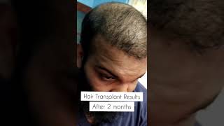 2024 Hair Transplant Results after 2 months MedLinksHairTransplants shorts [upl. by Elak]