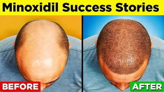 MINOXIDIL  A StepbyStep Guide to Regain Your Hair [upl. by Rotsen]