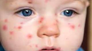 What is chickenpox Signs and symptoms of chickenpox [upl. by Ivets]