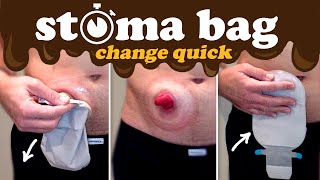 How to change an ostomy bag — quicker than 1 minute [upl. by Nikos]