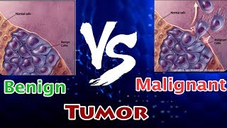 Benign Tumor Vs Malignant Tumor  Clear Comparison [upl. by Alded]