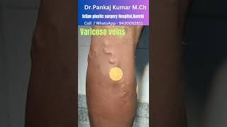 varicose veins treatment for SSC GD medical varicose veins treatment in Ranchi varicoseveins [upl. by Eveneg]