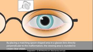 Cylinder in Prescription Glasses Astigmatism Correction [upl. by Nett12]