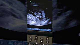 145 week fetal ultrasound [upl. by Mundford4]