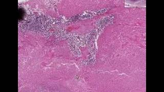 Histopathology Testis Embryonal carcinoma [upl. by Kissee]