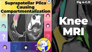 Fig 4C11 Suprapatellar Plica Causing Compartmentalization [upl. by Teirrah]