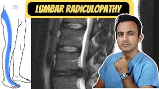 Lumbar Radiculopathy quotSciaticaquot [upl. by Barnes]