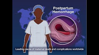 Early Detection and Treatment of Postpartum Hemorrhage  NEJM [upl. by Ignatz407]