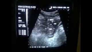 LT OVARIAN CYST with SOLID fixed area in it [upl. by Idolah240]