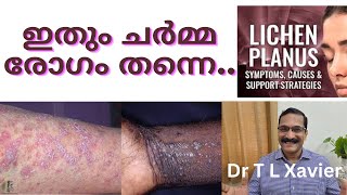 Lichen Planus Ayurvedic Solutions  Dr T L Xavier [upl. by Ecneralc]