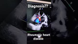 Rheumatic Heart Disease Diagnos [upl. by Eimile]