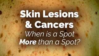 When is a Spot More than a Spot Skin Lesions and Cancers [upl. by Nadabas652]