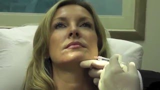 Rejuvenation of the Lower Face with Injectable Filler [upl. by Jamison]