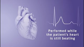 Treatment for tricuspid regurgitation at Northwestern Medicine [upl. by Ik995]