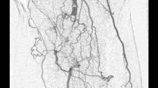 Arteriografia de membros inferiores  CIMI [upl. by Rohclem]