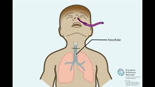 Trachéotomie pédiatrique en français [upl. by Laufer]