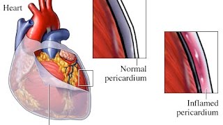 Pericarditis [upl. by Bullock]