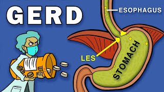 Gastroesophageal Reflux Disease GERD [upl. by Etteyafal]