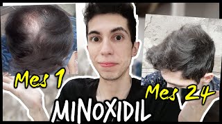 2 AÑOS usando MINOXIDIL para CAIDA de CABELLO  Mes 1 a Mes 24 ¡RESULTADOS [upl. by Talich779]