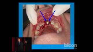 Learning from My Mistakes How to Drill Perfect Bicon Osteotomies Every Time [upl. by Sternick]