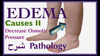 Pathology  Edema causes Decrease Osmotic Pressure  👨🏻‍⚕️ شرح باثو [upl. by Smoot877]