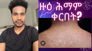 ሕማም ቀርበት pityriasis versicolor [upl. by Anaujat942]