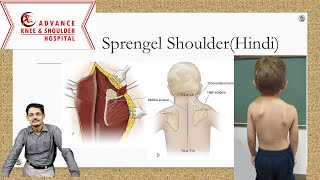 Sprengel Shoulderhindi [upl. by Irrahs]