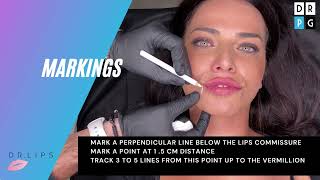 iLips® technique how to lift lips commissure during lips filler [upl. by Amalbergas404]