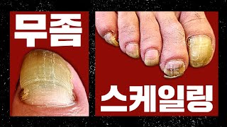 초록색 녹농균 발톱  Toenails with green Pseudomonas aeruginosa [upl. by Kenneth]