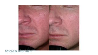 FDAApproved LaViv Fibroblast Treatment  Maryland Laser Skin amp Vein [upl. by Curnin302]