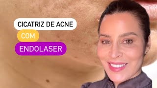 Endolaser para cicatriz de acne [upl. by Anailuj23]