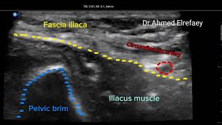 Suprainguinal fascia iliaca block ultrasound guided [upl. by Analart592]