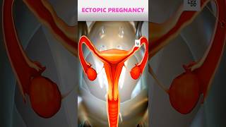 Ectopic pregnancypregnancy pregnancyjourney [upl. by Annis865]