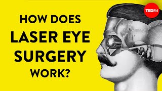 How does laser eye surgery work  Dan Reinstein [upl. by Iram]