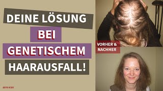 Erfolgreiche Behandlung von genetisch bedingtem Haarausfall mit Kaya Veda Produkten [upl. by Lally168]