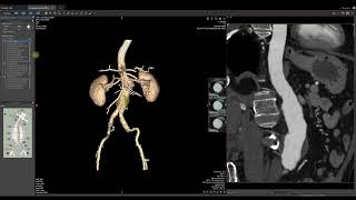 Vitrea Demonstrations  Endovascular Stent Planning EVSP [upl. by Lleroj951]