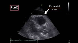 Pericardial Effusion with Doppler Echocardiographic criteria for Tamponade [upl. by Stephenie]