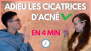 En finir avec les cicatrices d’acné en 4 minutes [upl. by Ahsiyk]