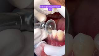 IPR BRACES Orthodontics Treatment [upl. by Tu663]