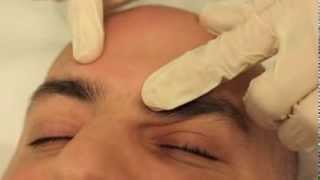 Sebaceous Hyperplasia removal [upl. by Dante]