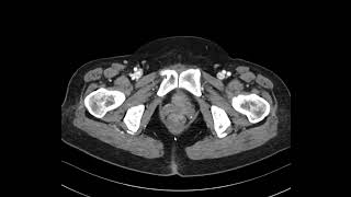 GB adenomyomatosis 2 [upl. by Aramenta]