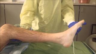 Ankle clonus [upl. by Hubey]