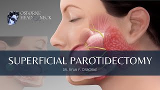 Superficial Parotidectomy Minimally Invasive Parotid Tumor Removal Explained By Dr Ryan Osborne [upl. by Ynnot]