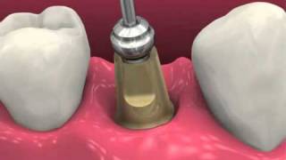 Restoring BioHorizons Dental Implants 2011 [upl. by Kelsi686]