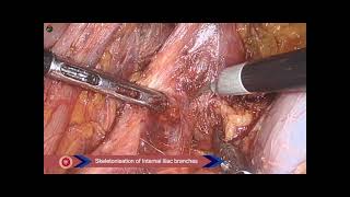 Fluorescence guided Laparoscopic Lateral Pelvic Lymphnode Disection in rectal cancer [upl. by Martsen]