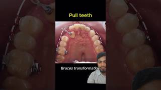 Dental braces treatment [upl. by Datnow]