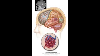 cavernoma  hge mets [upl. by Womack500]